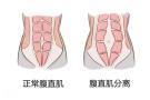 腹直肌分离修复百科