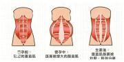 产后腹直肌修复的核心关键是什么？