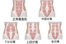 女生小肚子突出?警惕腹直肌分离! 女生小肚子突出?警惕腹直肌分离!